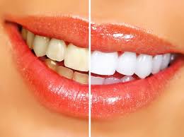 Teeth Whitening Liverpool, NY